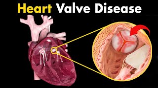 Heart Valve Disease  Symptoms Causes And Treatment [upl. by Almeta]