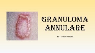 Granuloma annulare  associated conditions mechanism [upl. by Syla]