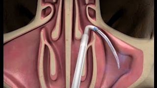 Balloon Sinuplasty Procedure with ENT Dr Timothy Ragsdale [upl. by Jegar308]