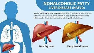 NAFLD NonAlcoholic Fatty Liver Disease [upl. by Atnoed452]