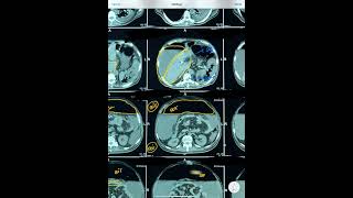 CHALLENGING CT ABDOMEN SPLENIC INFARCTIONPNEUMOPERITONEUMASCITIS [upl. by Rehprotsirhc]