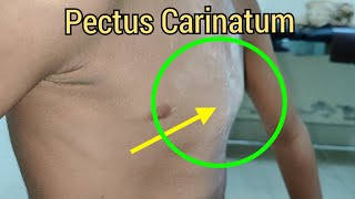 Pectus Carinatum or Pigeon Chest in a Child [upl. by Ahsinra]