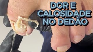 ELE ESTAVA COM MUITA DOR DEVIDO A CALOSIDADE NO DEDÃO satisfying viral [upl. by Ahseiyk952]