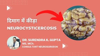 What is neurocysticercosis  Tapeworm  How it spreads  Treatments [upl. by Auhsaj475]