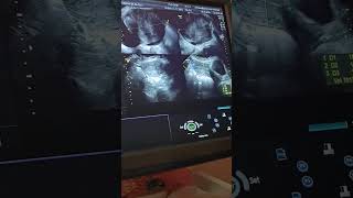 fibroid uterus e mucinous cystadenoma ultrasound [upl. by Analeh687]