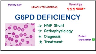 G6PD Deficiency  PathophysiologyClinical FeaturesLab DiagnosisTreatment pathology biochemistry [upl. by Maurene]