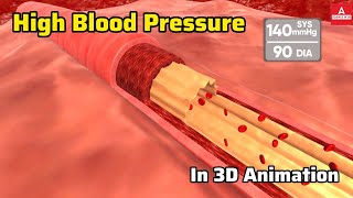 High Blood Pressure Explained in 3D  Understanding Hypertension [upl. by Nonnel]