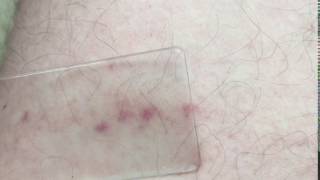 Glass test  Meningitis rash [upl. by Zerdna]