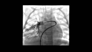 Pulmonary Arteriovenous MalformationsVascular Plug Embolisation [upl. by Noryd]