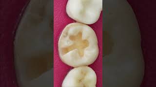 Fantastic Tooth Caries Restorationshorts [upl. by Isidro]