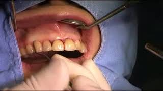 subgingival curettage [upl. by Evatsug]