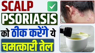 Head psoriasis removal  स्कैल्प सोरायसिस को ठीक करेंगे ये चमत्कारी तेल  Oil for scalp itching [upl. by Fabozzi]