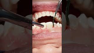 Class V tooth caries composite restoration dentisry [upl. by Atiuqcir]