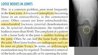 Orthopedics 345 loose bodies knee joint osteophytes OsteoArthritis locking joint [upl. by Hallutama]