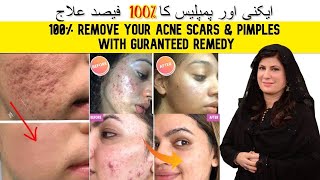 100 REMOVE ACNE SCARS PIMPLES ACNE WITH GUARANTEED TREATMENT IN URDU  HINDI BY DR BILQUIS SHAIKH [upl. by Checani]