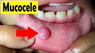 How to cure Mucocele  Home Remedies for a Mucocele [upl. by Ellennod]