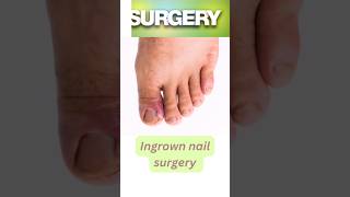 Ingrown Toe Nail Surgery  चमड़ी में धंसे नाखून की सर्जरी ingrownnailclip ingrowntoenailsurgery [upl. by Trella]