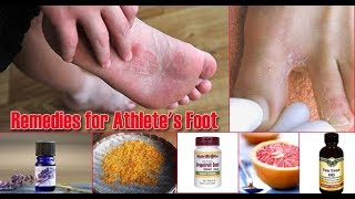 10 Natural Remedies for Athlete’s Foot  home remedy for athletes foot [upl. by Divadnhoj]