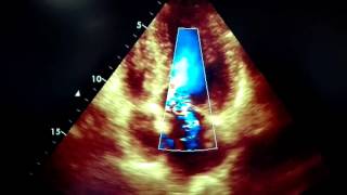 HYPERTROPHIC CARDIOMYOPATHY DYNAMIC LVOT OBSTRUCTION SAM [upl. by Ceporah784]