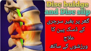 Disc buldgeDisc slipBackpain treatment at home Exercises for disc pain UrduHindi [upl. by Ottillia]