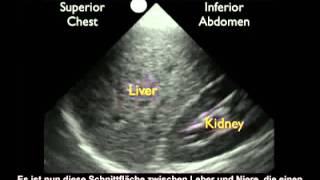 Anleitung FASTUntersuchung des rechten Oberbauchs – normale Untersuchung [upl. by Ellenij]