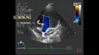 muscular ventricular septal defectVSD [upl. by Jeffrey]