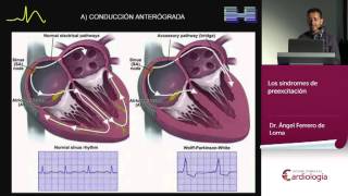 Los síndromes de preexcitación [upl. by Siurtemed870]