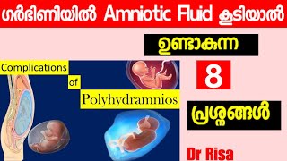 Complications of pregnancy MalayalamComplication of Increased Amniotic Fluild Level [upl. by Niltak]