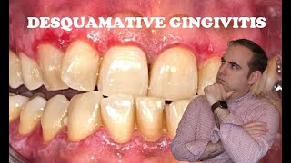 Essential Differential Desquamative Gingivitis [upl. by Larimore]