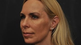 Juvederm Voluma Cheek Filler Demo by Dr Craig Jonov The Gallery of Cosmetic Surgery  Seattle [upl. by Nazler361]