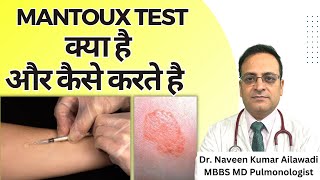 Mantoux Test क्या है और कैसे करते है  Mantoux tuberculin skin test TST TB Test  Diagnosis of TB [upl. by Chlo]