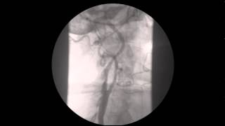 STENT CAROTIDEO  CAROTID ARTERY STENTING [upl. by Davies]