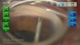 Dr Ike Ahmed  iStent inject W Surgical Footage [upl. by Leirad]