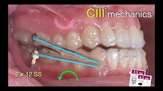 Solving anterior Crossbite with Aligners｜【Chris Chang Ortho】CC808 [upl. by Noonan733]