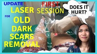 Laser Old Dark Scars Removal First SessionDoes it hurt How Much does laser Cost  Part 4 [upl. by Nagle]