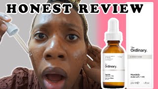 I TRIED THE ORDINARY MANDELIC ACID 10 FOR MY ACNE EVERYDAY FOR 2 WEEKS THESE ARE MY RESULTS [upl. by Halland]