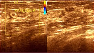 Chronic mastitis  Mastalgia  Breast Inflammation [upl. by Masry]