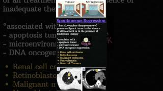 Spontaneous Regression of Tumour  Self regressing tumours  robbinspathology neetpg pathology [upl. by Ariamoy]