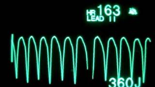 Pulseless Ventricular Tachycardia pVT  Monophasic Defibrillation at 360 Joules [upl. by Kirt753]