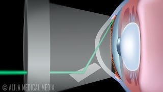 Laser Trabeculoplasty for Glaucoma ALT vs SLT Animation [upl. by Archibold]