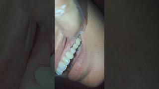 Failed dental bridge dentist dentalbridge dentalworld dentalrestoration dentalcare art smile [upl. by Cecilius]