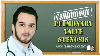 Pulmonary valve stenosis  clinical picture symptoms and signs ECG treatment Prognosis [upl. by Frannie]