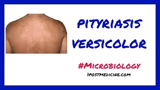 Pityriasis Versicolor By Dr Manish Soni  Dermatology [upl. by Diba106]