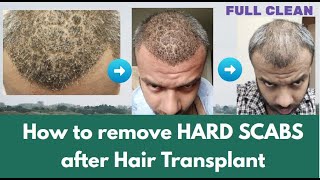 How to remove Hard Scabs after Hair Transplant  KV Hair Care amp Life [upl. by Etteniotnna]