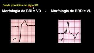 CURSO DE ELECTROCARDIOGRAFIA 48  EXTRASÍSTOLES VENTRICULARES [upl. by Natloz]