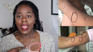 My Skin Story  How I got rid of Pityriasis Rosea  TheAdeTomi [upl. by Sundin]