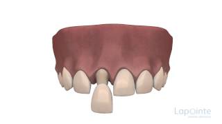 Fermeture de diastème  Centres dentaires Lapointe [upl. by Berger]