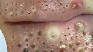 Big Cystic Acne Blackheads Extraction Blackheads amp Milia Whiteheads Removal Pimple Popping  703 [upl. by Nrubliw602]