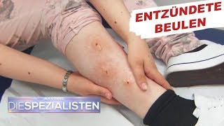 Beulen an den Beinen Parasitenbefall  Auf Streife  Die Spezialisten  SAT1 TV [upl. by Leschen]