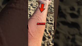 How To Survive a Jellyfish Sting 😨 [upl. by Brody231]